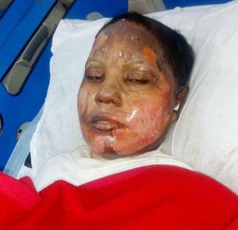 Victims of Islamic Jihad: 25 year old Christian girl was set on fire after the Acid attack on her by an Islamist Radical on refusal to convert to Islam and marry him.