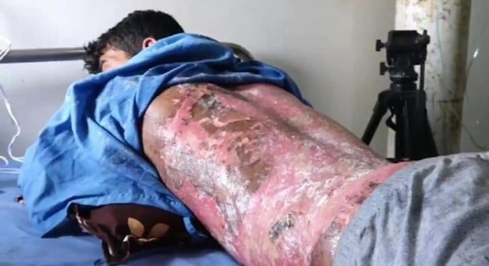 Turkey Committing War crimes in Syria. A man with burn injuries due to chemical weapons being treated in the hospital.
