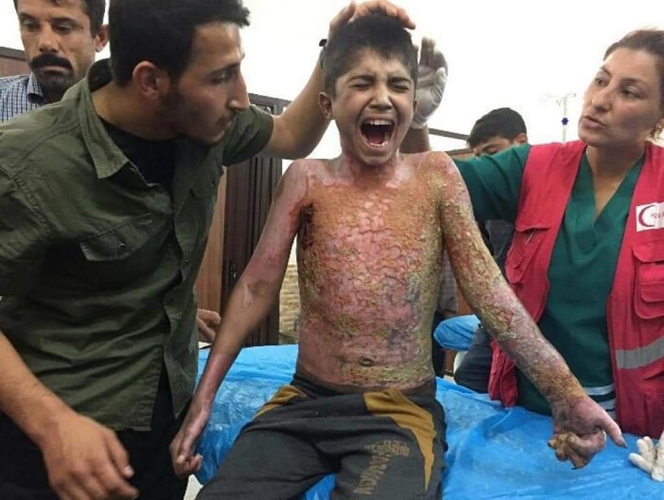 Turkey Committing War crimes in Syria. Child with burn injuries due to chemical weapons being treated in the hospital.
